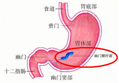 为什么幽门螺旋杆菌关注度这么高？