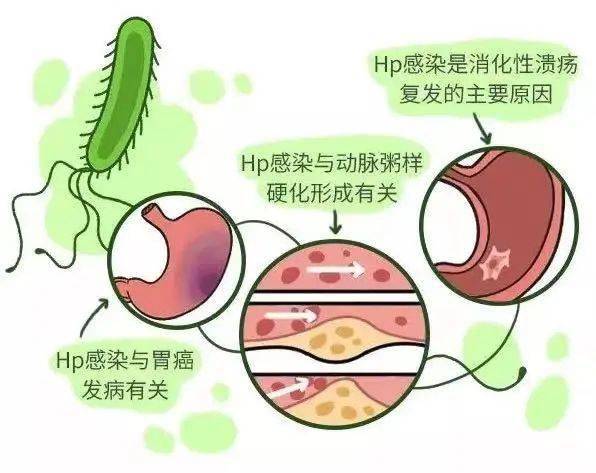 素颜说说 幽门螺杆菌检查阳性，究竟要不要治？ 