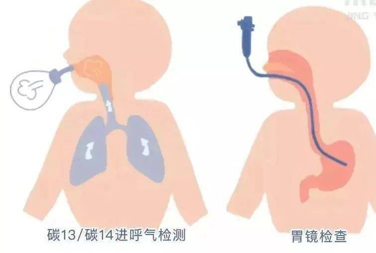 就体检写给正在和幽门螺杆菌抗争中的你