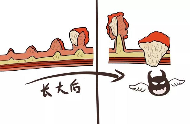 胆囊息肉.jpg