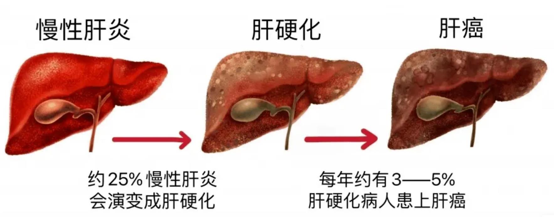 预防肝病做好这几点，避免肝病发展为肝癌