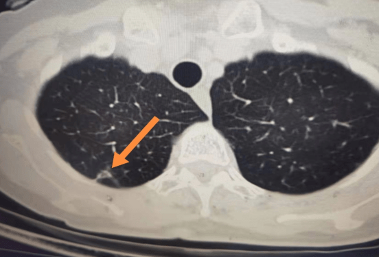 肺癌早期很难觉察，该如何做到科学体检？