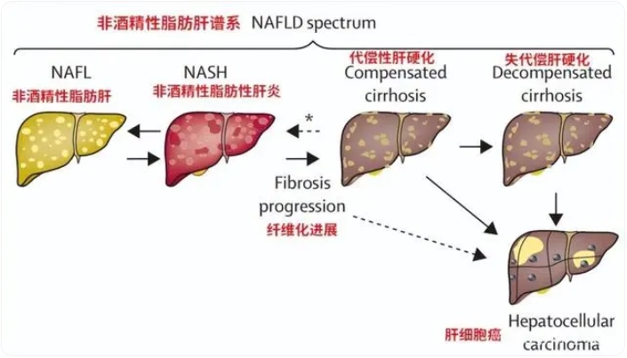 体检时查出脂肪肝，该怎么办？